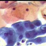 Ανισομεγέθεις πυρήνες μεταπλαστικών κυττάρων.. Φυσιολογικά οξεόφιλα κύτταρα επιφ. στοιβάδας